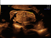 Unilateral renal agenesis coronal